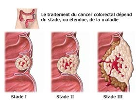 Stadification du cancer colorectal